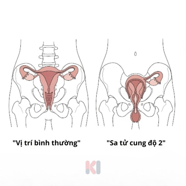 Sơ đồ y khoa so sánh chi tiết vị trí tử cung bình thường và tình trạng sa tử cung độ 2.